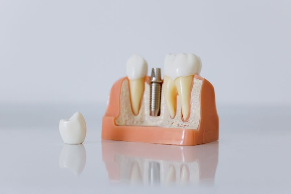 Reviewing whether dental insurance covers implants
